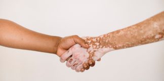 O vitiligo é uma patologia que traz consigo muitos estigmas e preconceitos, tanto de seu portador quanto das pessoas à sua volta. A doença acometeu o astro do pop Michael Jackson