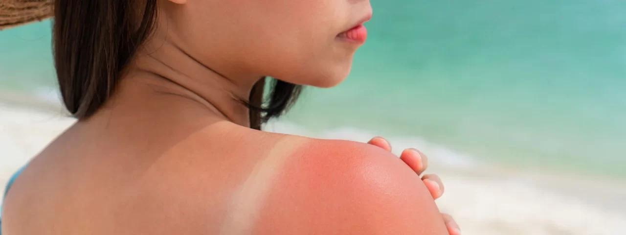 Cuidado com os perigos da exposição excessiva ao sol: saiba como se proteger
